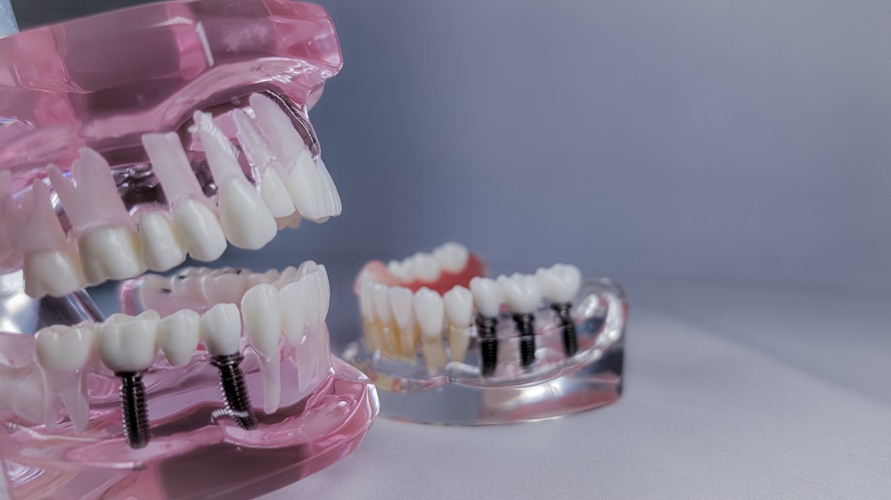 dental implant restoration Griffin